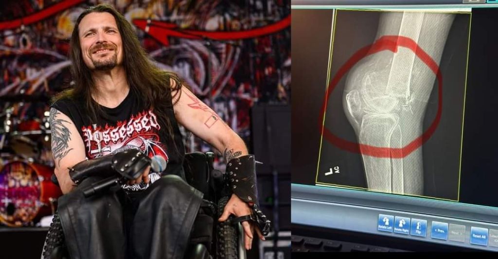 jeff-becerra-de-possessed-sufre-fractura-de-fmur-noticias-sin-categoria